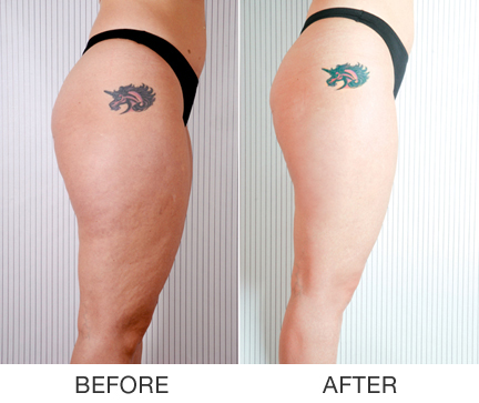 Allenamento contro la cellulite